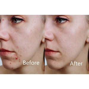 Aphrona LED facial mask, the ideal mask for your face
