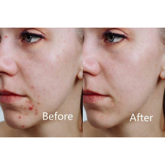 Aphrona LED facial mask, le masque idéal pour votre visage