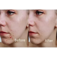 Aphrona LED facial mask, le masque idéal pour votre visage