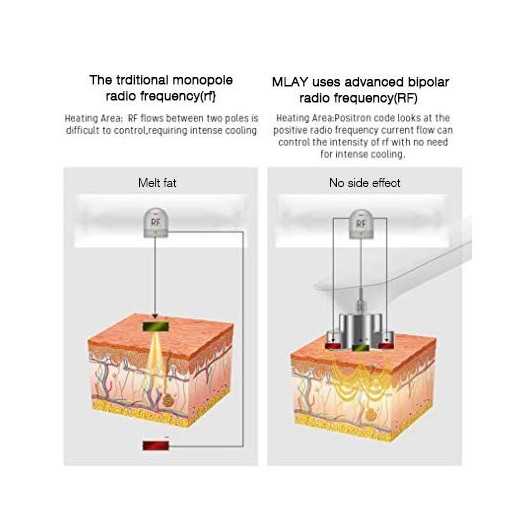 MLAY RF, l'appareil qui resserre la peau