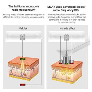 MLAY RF, l'appareil qui resserre la peau