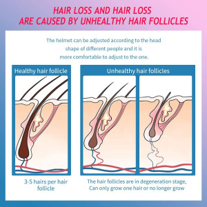 CNV, le casque de repousse pour cheveux