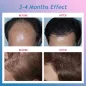 Système CNV Anti-Chute: Revitalisez vos Cheveux avec la Thérapie LED!