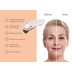 Sensica Sensilift, a radio frequency facelift