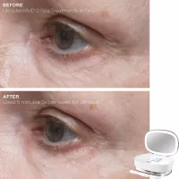 Trophy Skin UltradermMD: At-Home Microdermabrasion for Radiant, Youthful Skin