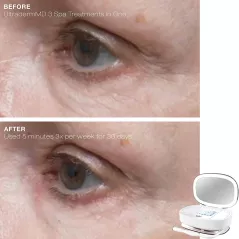 Trophy Skin UltradermMD: At-Home Microdermabrasion for Radiant, Youthful Skin