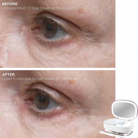 Trophy Skin Ultraderm®, the facial suction