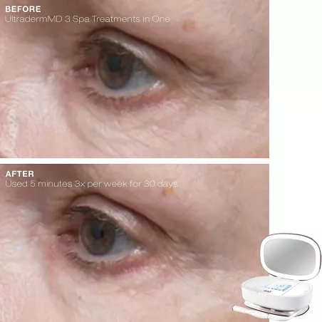 Trophy Skin UltradermMD: At-Home Microdermabrasion for Radiant, Youthful Skin
