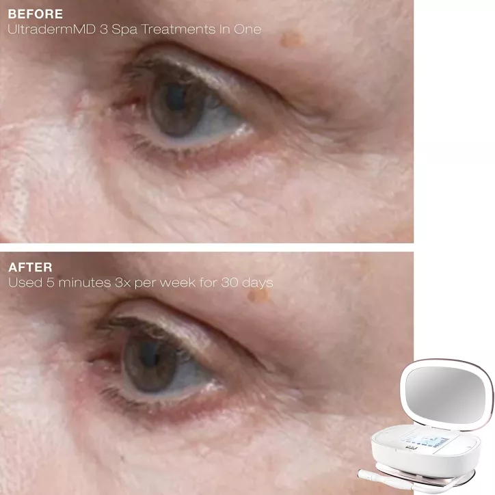 Trophy Skin UltradermMD: At-Home Microdermabrasion for Radiant, Youthful Skin