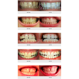 AuraGlow Deluxe Home, the teeth whitening system