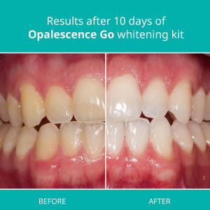 Opalescence Go, les plateaux de blanchiment de dents