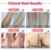 Imene T4, the permanent hair removal device