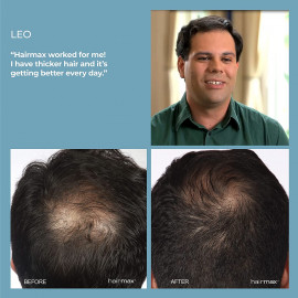 HairMax Laser Hair Growth Comb | FDA Cleared Treatment