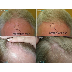 HairMax RegrowMD Laser Hair Growth Cap, FDA Cleared, 272 Medical Grade Lasers, Hair Loss Treatment for Men and Women, Full Scalp