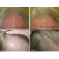 HairMax RegrowMD: Révolution Capillaire au Laser, Résultats Prouvés!