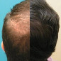 CapillusUltra Laser Hair Regrowth Cap: FDA-Cleared, Stop Hair Loss & Regrow Thicker Hair!