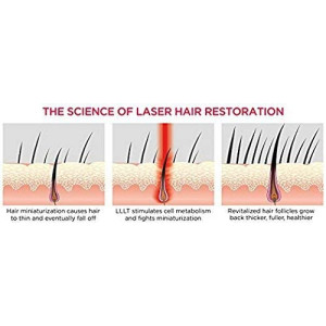 iRestore Essential Laser Hair Growth System | FDA Cleared Hair Regrowth Laser Cap - Red Light Therapy Hair Growth, Hair Loss