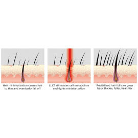 FDA Cleared iRestore Laser Hair Growth System - New Technology