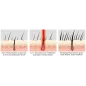 iRestore : Système Laser Anti-Chute de Cheveux Approuvé FDA - Repousse Efficace pour Hommes et Femmes