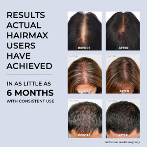 Hairmax Hair Growth Laser Band (FDA Cleared), LaserBand 82 ComfortFlex, Full/Partial Coverage, Hair Growth for Men & Hair
