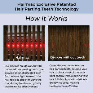 Hairmax Hair Growth Laser Band (FDA Cleared), LaserBand 82 ComfortFlex, Full/Partial Coverage, Hair Growth for Men & Hair