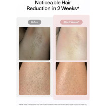 Ulike IPL Laser Hair Removal - Ice-Cooling, Painless Hair Removal