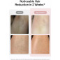 Ulike Air 10 IPL Hair Removal: Ice-Cooling, Dual Lights, Lasting Smoothness
