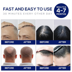 Laser Hair Growth Cap - Red Light Therapy for Hair Regrowth