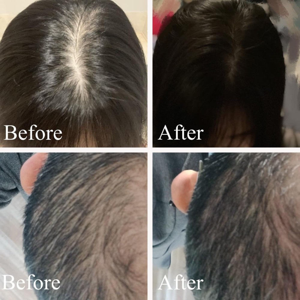 FDA-Cleared Laser Hair Growth Cap for Men and Women