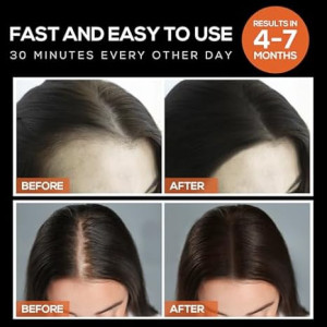 Laser Hair Growth Cap: Low-Level Laser Therapy for Effective Hair Regrowth