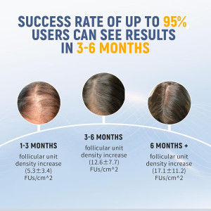 Laser Comb : Stimule la Croissance des Cheveux Efficacement