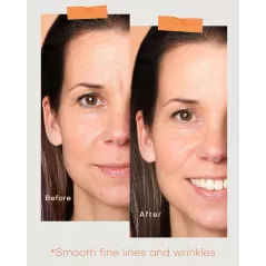 Masque LED Ultra-léger Anti-rides & Acné - NEWKEY
