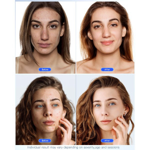 NEWKEY LED Face Mask Therapy for Wrinkles & Acne, 150 LEDs, Auto Off