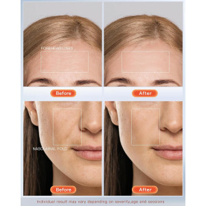 NEWKEY LED Face Mask Therapy for Wrinkles & Acne, 150 LEDs, Auto Off