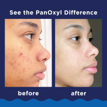PanOxyl Acne Wash 10% Benzoyl Peroxide Maximum Strength 5.5 Oz