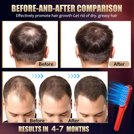 Peigne Laser Croissance Cheveux Rouge - Traitement Unisexe