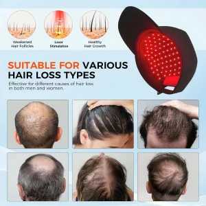 Red Light Laser Hair Growth Cap – Adjustable, Portable Hair Regrowth