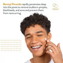 AcneFree Terminator 10% Benzoyl Peroxide - Crème Anti-Acné