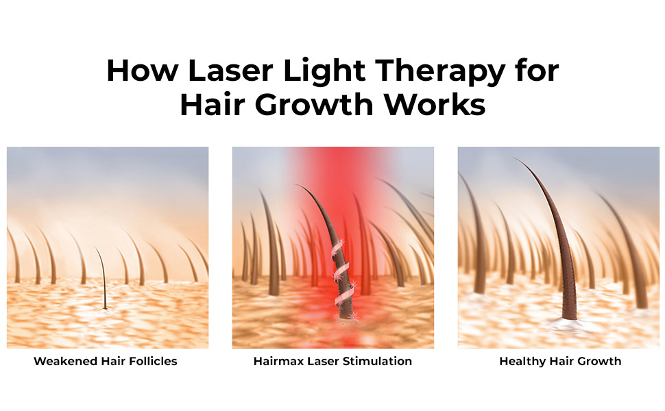 How laser light therapy works with Hairmax LaserBand 82