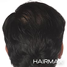 HairMax Laser Stimulation