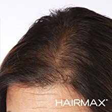 HairMax Laser Stimulation