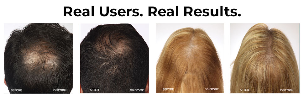 Before and after using Hairmax laser therapy