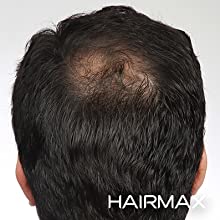 HairMax Laser Stimulation